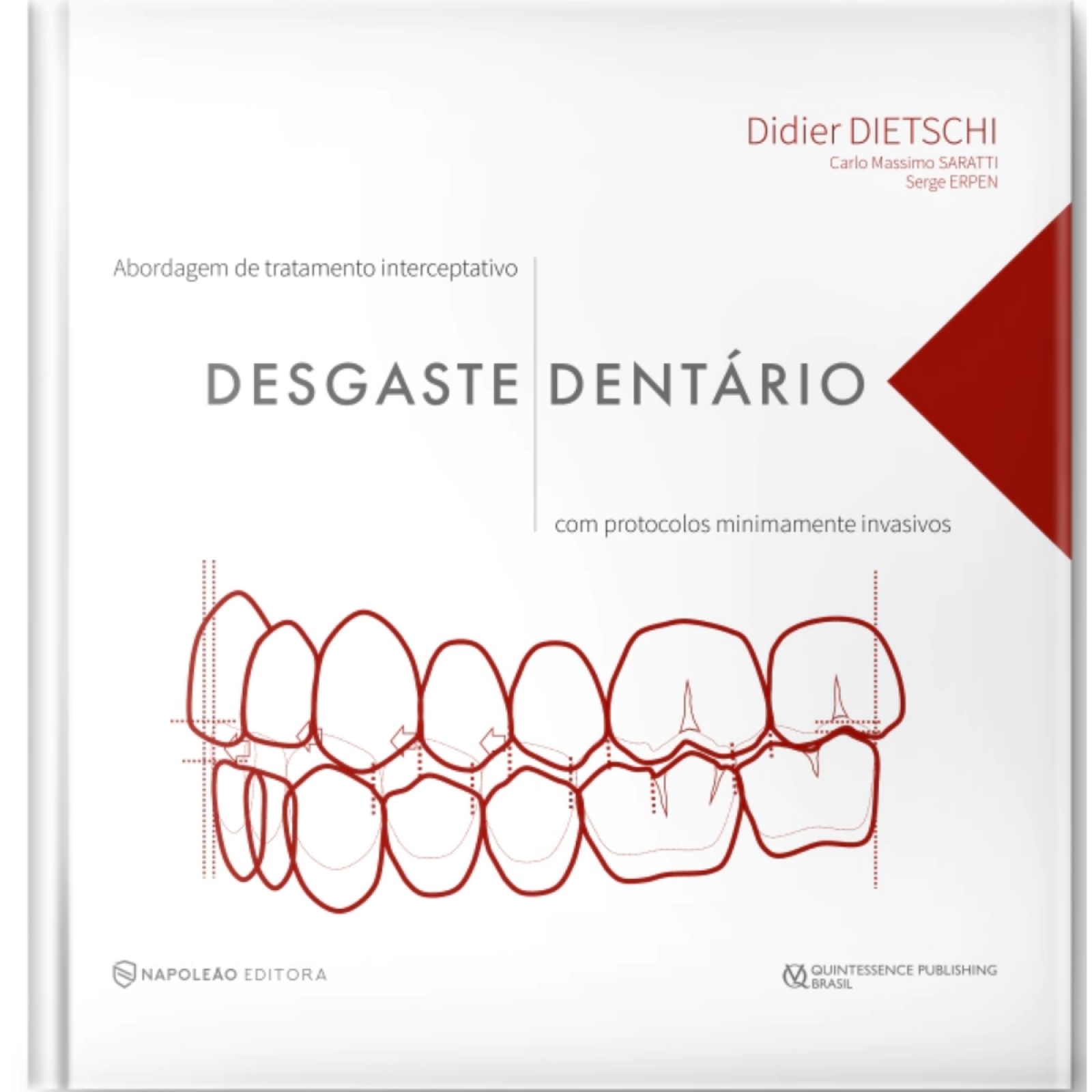 Desgaste Dentário - Abordagem De Tratamento Interceptativo Com Protocolos Minimamente Invasivos