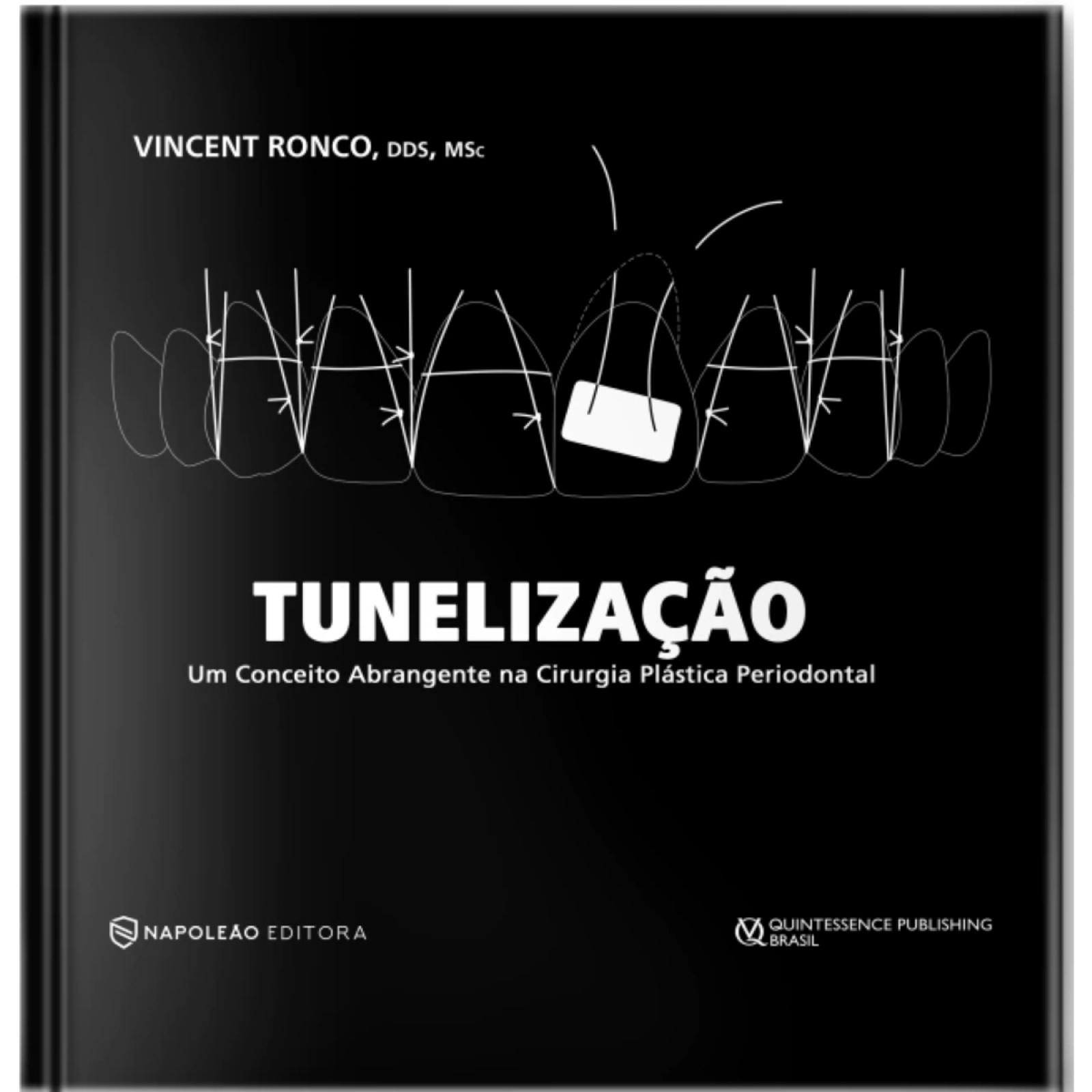 Tunelização Um Conceito Abrangente Em Cirurgia Plástica Periodontal