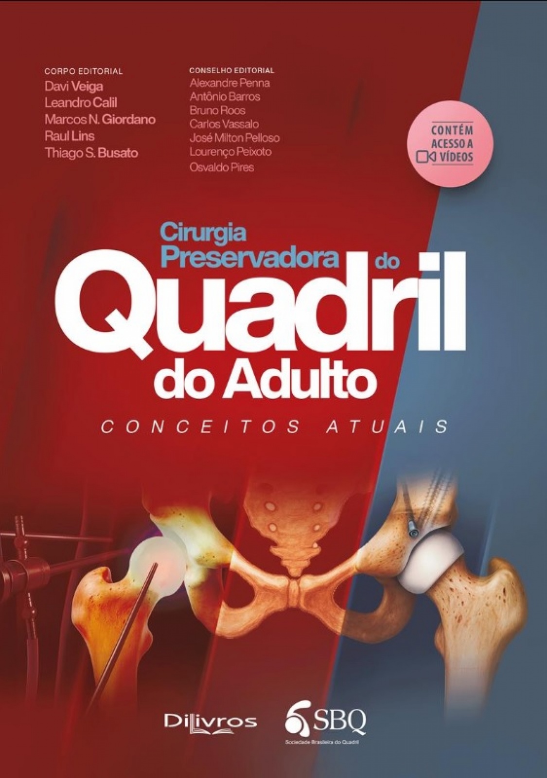Sbq Cirurgia Preservadora Do Quadril Do Adulto: Conceitos Atuais