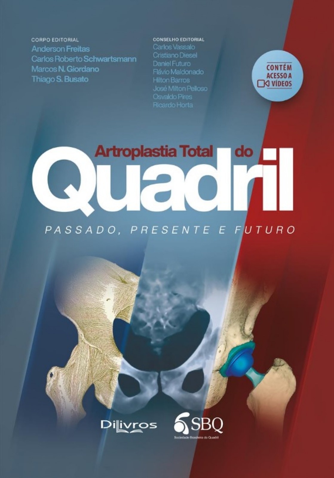 Sbq Artroplastia Total Do Quadril: Passado, Presente E Futuro