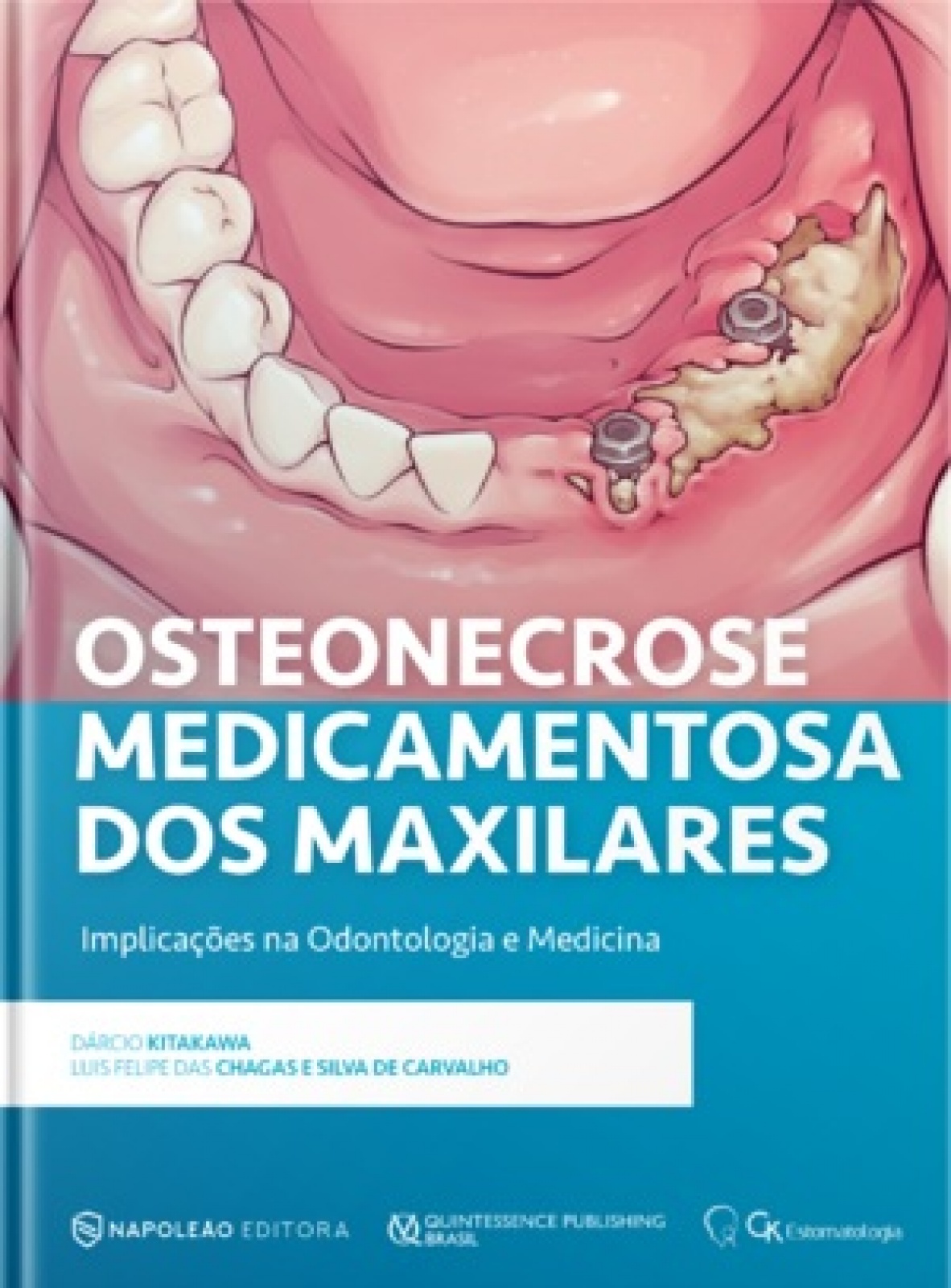 Osteonecrose Medicamentosa Dos Maxilares - Implicações Na Odontologia E Medicina